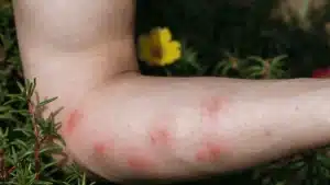 symptoms of ant bitten